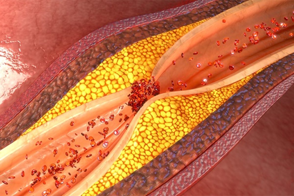 Artist's rendering of the interior of an artery showing plaque